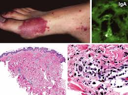 You may have other symptoms depending on what is causing your purpura. Henoch Schonlein Purpura Iga Vasculitis Cancer Therapy Advisor