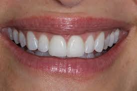 Less expensive than porcelain veneers. Composite Bonding Vs Porcelain Veneers Which Is Better Enlighten Smiles Blog