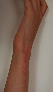 What is the best remedy to cure the. How To Identify Bed Bug Bites Triangle Pest Control