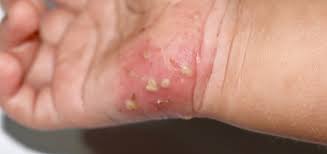 Image result for scabies human bites