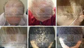 I'm part of the 50 percent you don't want to be in. Hair Loss Solutions Home Facebook