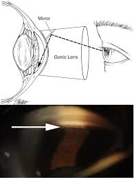 Image result for Gonioscopy