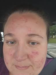 Acne after gastric bypass surgery