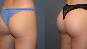 A woman went into surgery thinking she was going to wake up with a perfect tushie, and instead woke up with a botched tummy tuck. Brazilian Butt Lift Bbl Terrifying Plastic Surgery Warning