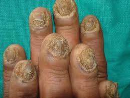 Image result for onychomycosis