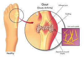 11 Essential Oils For Gout Plus Mixtures And Application Tips Essential Oils For Gout Home Remedies For Gout Gout Remedies
