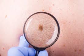 This is why it's so important to review these skin cancer pictures and know what skin cancer looks like. Five Little Known Things About Skin Cancer Lluh News