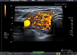 Jakie są przyczyny choroby jak objawia się nadczynność tarczycy jak ją zdiagnozować i leczyć. Nadczynnosc Tarczycy Endokrynologia