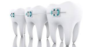 Find more information on dental aligners and how to straighten teeth at home. Broken Braces What To Do If A Bracket Or Wire Breaks Don T Panic