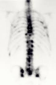 Bony metastases from prostate cancer shown by a bone scan. Bone Scans In Diagnosis Of Prostate Cancer The New Prostate Cancer Infolink