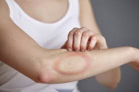 Für die meisten infizierten personen ist die krankheit damit bereits überstanden. Borreliose Symptome Erkennen