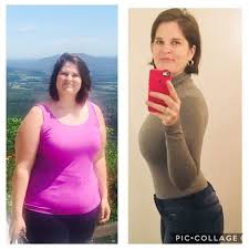 See gastric sleeve before and after photos. Gastric Sleeve Tijuana Mexico Monterrey Mexico Tijuana Bariatrics Llc