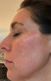 In-Home Medical Aesthetics Treatments