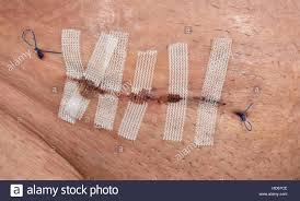 Alibaba.com offers 321 steri strips products. Genahte Wunde Stockfotos Und Bilder Kaufen Alamy