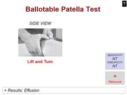 Image result for Ballottable Patella Sign