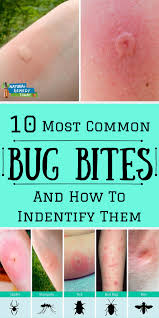 There are natural insecticides that bed bugs hate. 10 Most Common Bug Bites Bug Bites Remedies Itchy Bug Bites Types Of Bug Bites