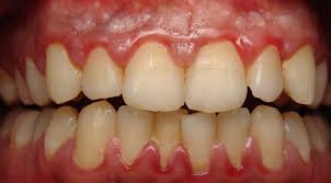 Image result for gums cancer symptoms