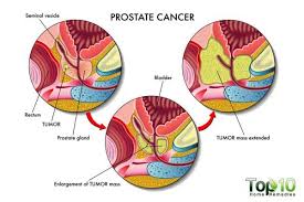 Men who decide to take testosterone therapy may be at an increased risk of developing prostate cancer. Prostate Cancer Most Common Cancer Among Males In Qatar Marhaba Qatar