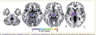 Image result for Neurologic Lesion Localization