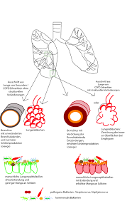 Für copd patienten sind beide wirkungsweisen des cornets sinnvoll. Copd Veranderte Lunge Verandertes Mikrobiom