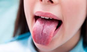 Vom imparti acest articol doua capitole, deoarece difera foarte mult timpul petrecut pentru fiecare judet in parte. Glosodinia Usturimea Limbii Tratament