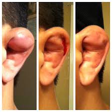 Cauliflower Ear A Grappler S Dilemma Gracie Barra The pathology of cauliflower ear is fairly well understood. cauliflower ear a grappler s dilemma