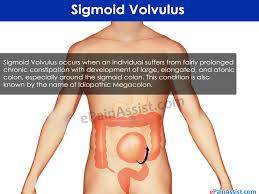 Sigmoid Volvulus Causes Symptoms Treatment Diet