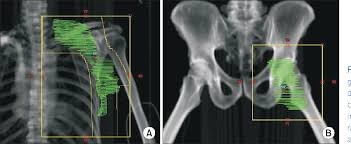Now his hind leg is sore and it seem swollen on 1 side in his groin area.? Figure 1 From Dosimetric Comparison Of Axilla And Groin Radiotherapy Techniques For High Risk And Locally Advanced Skin Cancer Semantic Scholar