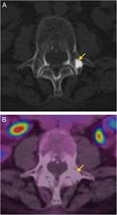 A backbone is the part of the computer network infrastructure that interconnects different networks and provides a path for exchange of data between these different networks. Bone Up On Spinal Osseous Lesions A Case Review Series Insights Into Imaging Full Text