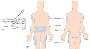 The body areas most commonly used for insulin injections are the abdomen, buttocks, and thighs and the backside of the upper copyright © 2019 medical pictures info. Olcreate Heat Ncd Et 1 0 Non Communicable Diseases Emergency Care And Mental Health Module 2 Diabetes Mellitus Figure 2 5 A Diagram Showing The Penetration Of A Subcutaneous Needle For Injecting Insulin B Preferable Injection Sites For