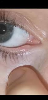 Entzundung Im Auge Augen