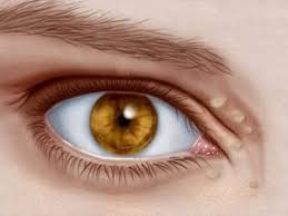 În aspectul ei seamănă cu mei, se află în zona pleoapelor și pe față. Xantoame Xantelasme Sau Puncte De Grasime Pleoape Pret Tratament Bucuresti