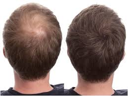 What's possible with stem cell cartilage regrowth? Stem Cell Therapy Hair Loss Treatment Arizona Hair Rejuvenation Center