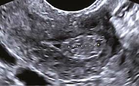 We did not find results for: Ultrasound Imaging Of Women With Abnormal Uterine Bleeding Aub Chapter 13 Ultrasound In Reproductive Healthcare Practice