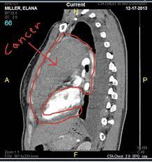 It looks like a milkshake in appearance. My Cancer Shows How Our World Is Ruled By Love