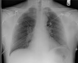 Radiology Residents On Call Interpretation Of Chest Radiographs For Congestive Heart Failure Academic Radiology This leads to fatigue, breathlessness and oedema (accumulation of. congestive heart failure