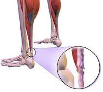 Achilles Tendon Pain Symptoms Causes And Treatment Orthofeet
