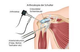 Schulterschmerzen Ursachen Ubungen Behandlung Gelenk Klinik De