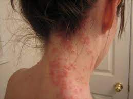 Celiac Disease And Can Cause Other Effects That Can Be Difficult And Painful Symptoms Of Celiac Disea Celiac Disease Allergy Symptoms Dermatitis Herpetiformis