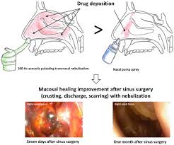 Budesonide Transnasal Pulsating Nebulization After Surgery In Chronic Rhinosinusitis With Nasal Polyps Springerlink