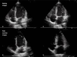 More specifically, it is described as. Exercise Echocardiography