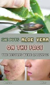 She Puts Aloe Vera On Her Face For 7 Days See The Results Aloe Vera For Skin Aloe Vera For Face Aloe Vera Acne (excuse me if i've written something wrong, english isn't my main language) well when i tried it for about a week and my face dried completely out.