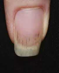 What do black lines in fingernails mean for your clients? Why Do I Get Dark Lines In My Fingernails Quora