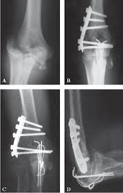A fracture of the medial epicondyle of the elbow that is the third most common fracture seen in children and is usually seen in boys between the age of most accurate but associated with increased radiation. Pdf Fracture Dislocation Of The Humeral Condyles In Adults Results Of Surgical Treatment Semantic Scholar