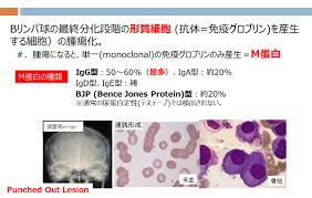 骨髄異形成症候群 refをクリックしていただくとreference abstractが表示されます（pub med） 本文は血液診療第5巻第1号の論文を改変し、掲載しております。 mdsでは血球の形態異常を伴います。赤芽球系においては核が多核の細胞 å¤šç™ºæ€§éª¨é«„è…« è¡€æ¶²å†…ç§' æ–°ç™¾åˆãƒ¶ä¸˜ç·åˆç—…é™¢