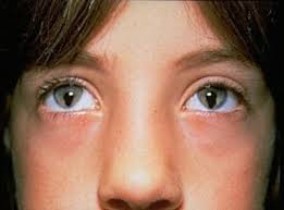 Cat Eye Syndrome Steemit
