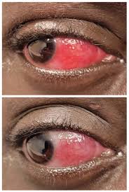 Image result for Scleritis