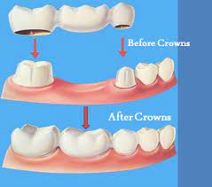 Pin On Dental Crowns Before And After Fit