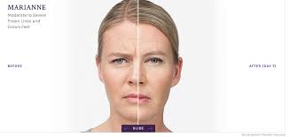 The frown lines between the brows can be address two different ways: Considering Botox Skin Iowa Cosmetology Dermatology Des Moines