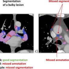 Pdf | on jan 1, 2013, m gutberlet and others published mrt bei myokarditis | find, read and cite all the research you need on researchgate Bettina Baessler Consultant Radiologist Research Group Leader University Of Zurich Zurich Uzh Institut Fur Diagnostische Und Interventionelle Radiologie